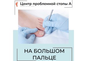 Зачистка утолщенной или инфицированной ногтевой пластины